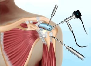 Artroscopia de Hombro - Procedimiento realizado por el Dr. Miguel Angel Barrios Andaluz en Tapachula