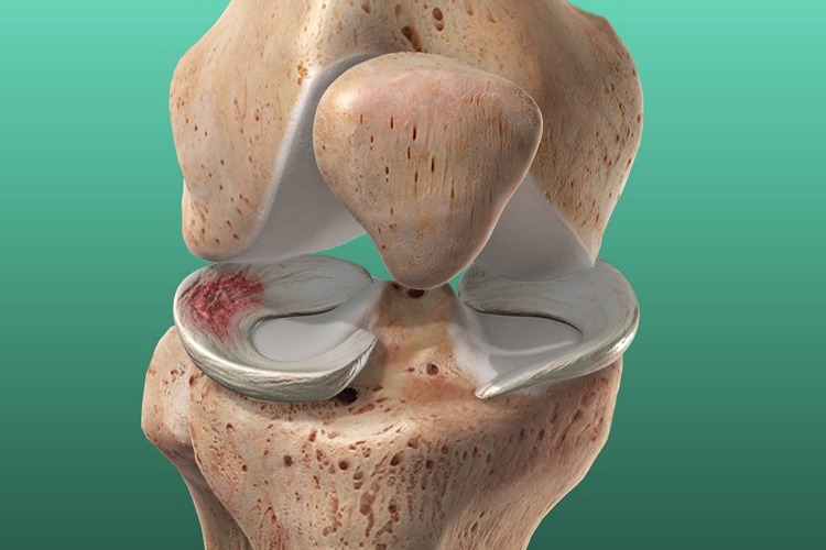 Lesión de Menisco - Enfermedad tratada por el Dr. Miguel Angel Barrios Andaluz