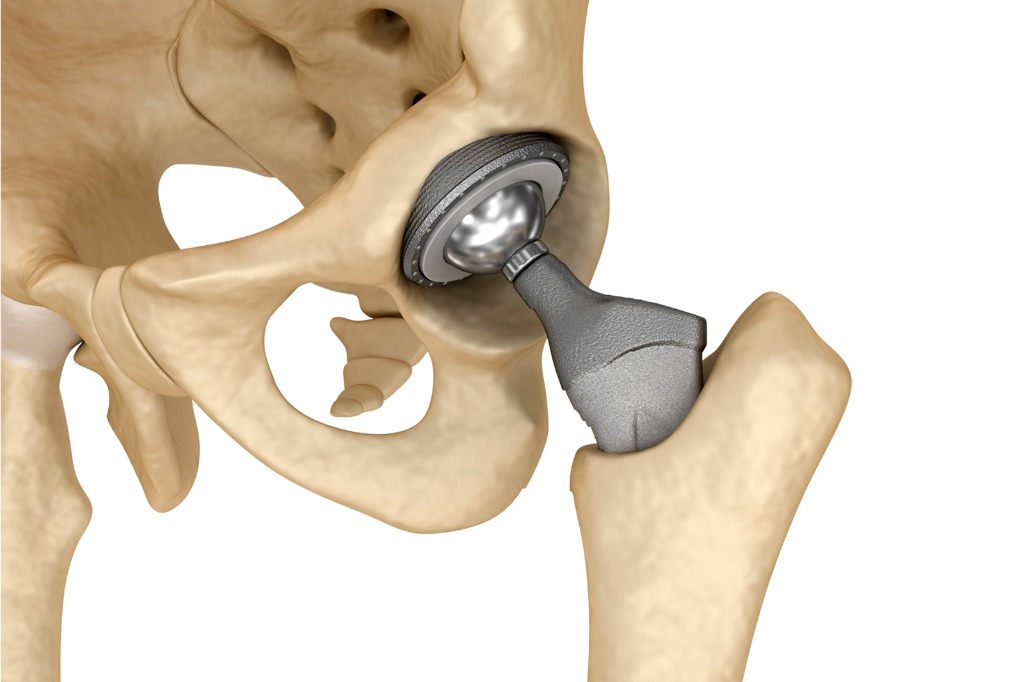 Prótesis Total de Cadera - Procedimiento realizado por el Dr. Miguel Angel Barrios Andaluz en Tapachula